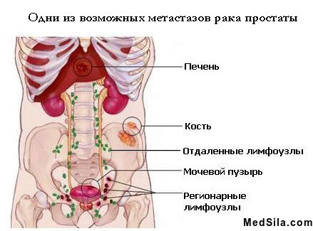 Метастазы рака простаты